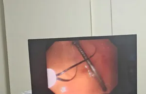 क्लैरिस हॉस्पिटल ने रचा नया कीर्तिमान: एंडोस्कोपी से पेट से निकाली कील