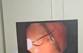 क्लैरिस हॉस्पिटल ने रचा नया कीर्तिमान: एंडोस्कोपी से पेट से निकाली कील