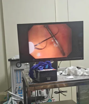 क्लैरिस हॉस्पिटल ने रचा नया कीर्तिमान: एंडोस्कोपी से पेट से निकाली कील