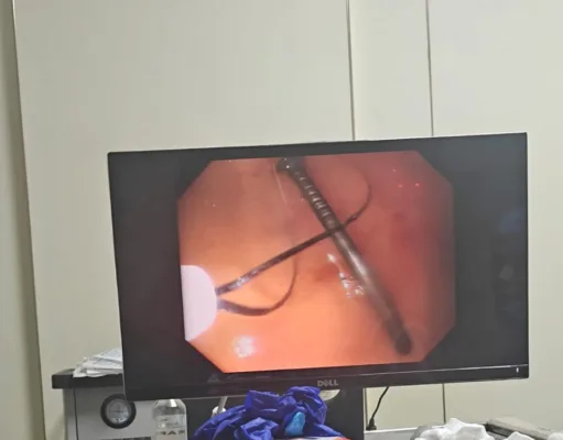 क्लैरिस हॉस्पिटल ने रचा नया कीर्तिमान: एंडोस्कोपी से पेट से निकाली कील